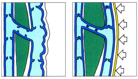 Diagram comparing veins with valves that won't close vs veins under compression therapy.